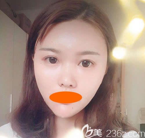 花28000元在西寧時光找祁永章醫(yī)生做了大腿抽脂+自體脂肪全臉填充后，覺得自己比原來好看多了