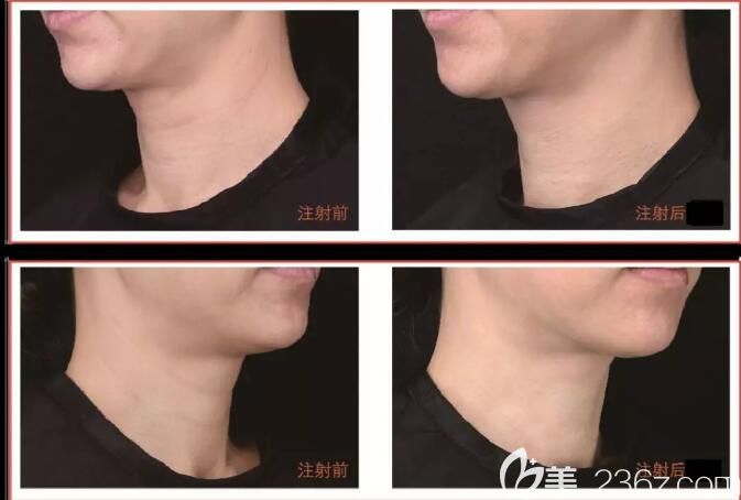 嗨體去頸紋案例對(duì)比