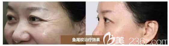 嗨體去除眼周皺紋案例分享