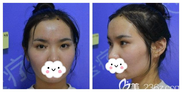 面診徐州時光洪揚術前太陽穴凹陷 面診徐州時光洪揚術前太陽穴凹陷