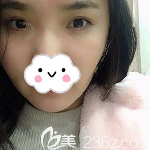 剛做完自體脂肪填充太陽穴術后效果 剛做完自體脂肪填充太陽穴術后效果