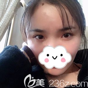 術后一周腫脹消除的太陽穴效果 術后一周腫脹消除的太陽穴效果