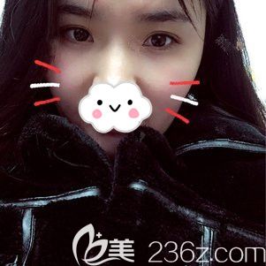 自體脂肪填充太陽穴術后20天效果 自體脂肪填充太陽穴術后20天效果