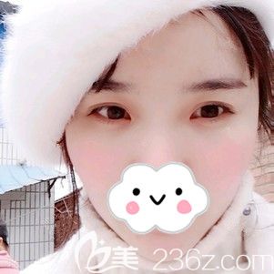 太陽(yáng)穴凹陷影響運(yùn)勢(shì)的我到徐州時(shí)光洪揚(yáng)做了自體脂肪填充 30ml帶來(lái)的改變是工作愛情雙豐收