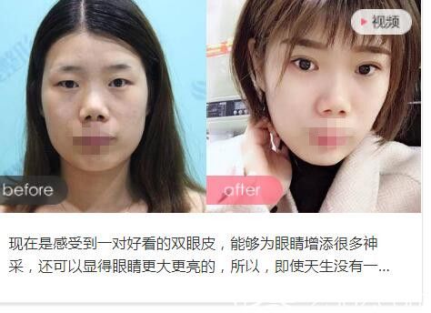 洛陽華美徐英杰醫(yī)生雙眼皮整形前后對比案例