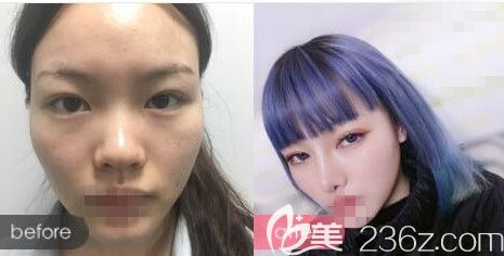 洛陽華美謝常禮醫(yī)生隆鼻前后對比案例