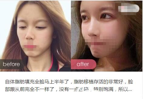 洛陽華美王旭明醫(yī)生自體脂肪填充前后對比案例