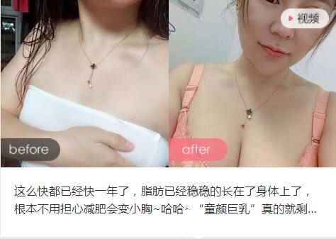 洛陽華美王旭明醫(yī)生自體脂肪填充前后對比案例 洛陽華美王旭明醫(yī)生隆胸前后對比案例