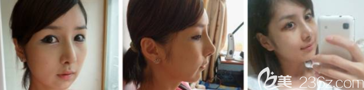 術(shù)后2周 術(shù)后2周