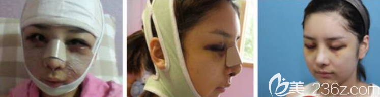 手術(shù)當(dāng)天 手術(shù)當(dāng)天