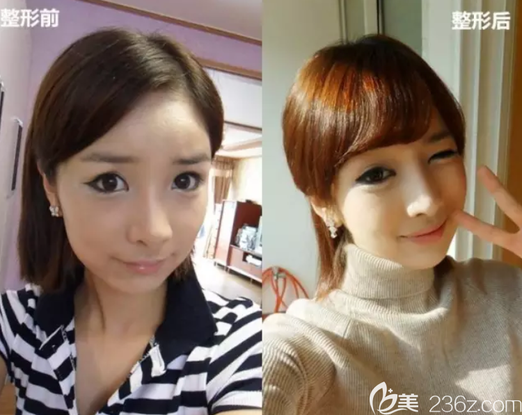 韓國高蘭得顴骨縮小真人案例 韓國高蘭得顴骨縮小真人案例