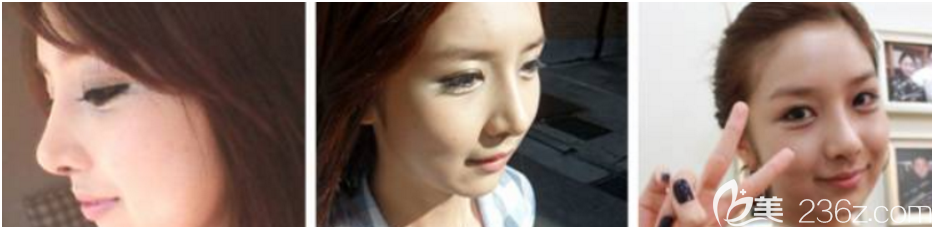 術(shù)后一個月 術(shù)后一個月