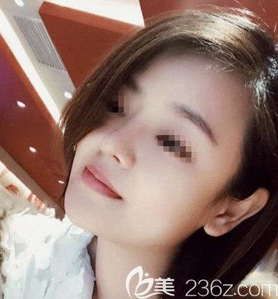 在韓國博朗溫整形外科做了3D CT 鼻綜合手術(shù)之后告別了我的大鼻頭和塌鼻梁