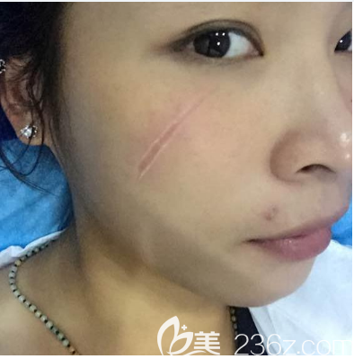 在深圳鵬程醫(yī)院疤痕科祛疤前的樣子 在深圳鵬程醫(yī)院疤痕科祛疤前的樣子