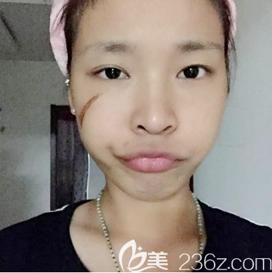 呂美琪醫(yī)生面部凹陷性疤痕治療一周效果圖 呂美琪醫(yī)生面部凹陷性疤痕治療一周效果圖