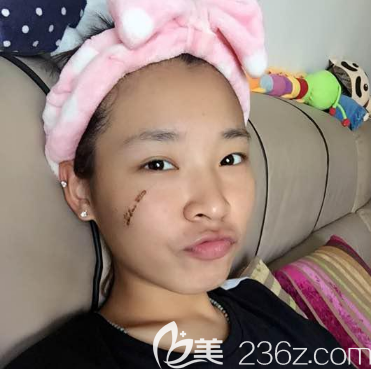 去深圳鵬程疤痕科治療疤痕九天開始脫痂 去深圳鵬程疤痕科治療疤痕九天開始脫痂