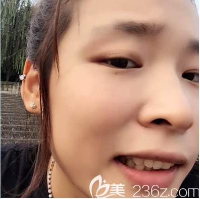 深圳祛疤痕哪家醫(yī)院好？瞧我在深圳鵬程醫(yī)院疤痕科找呂美琪做的臉上凹陷性疤痕修復(fù)效果怎么樣