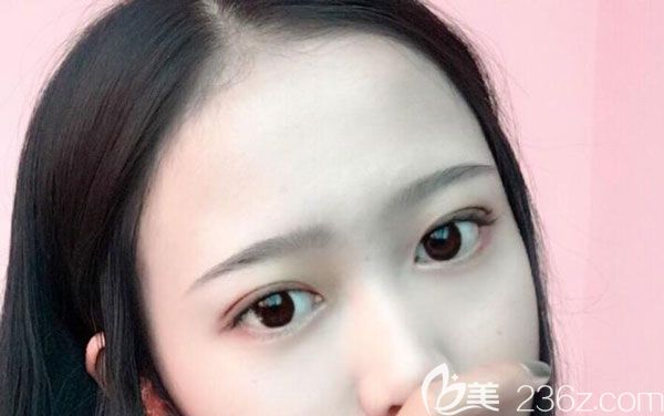 割雙眼皮手術(shù)40天沒(méi)有很假，一寬一窄的現(xiàn)象