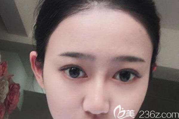 好開心喲！找昆明藝星金輝做眼綜合+提肌60天效果很自然，價(jià)格很合理