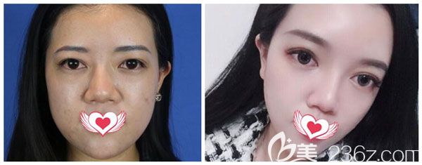 找昆明藝星白春燕用2支玻尿酸填充蘋果肌案例效果對(duì)比照，大家來評(píng)價(jià)一下怎么樣