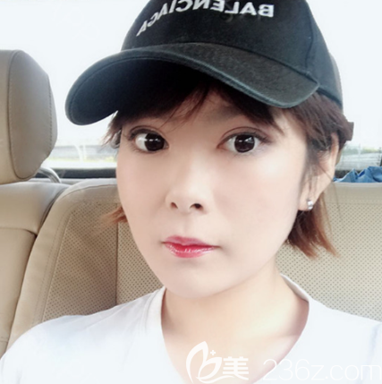 確定湛美是正規(guī)整形醫(yī)院后找陳海濤醫(yī)生做了全切雙眼皮手術(shù)