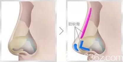 肋軟骨隆鼻效果好嗎？取肋軟骨隆鼻對(duì)身體有害嗎？
