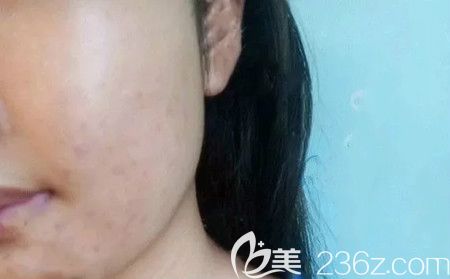 去贛州韓美整形醫(yī)院做微針祛痘術(shù)后第12天效果 去贛州韓美整形醫(yī)院做微針祛痘術(shù)后第12天效果