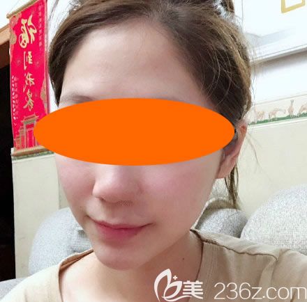 真沒想到花2800元找贛州韓美整形吳彩霞做微針祛痘后，僅僅1個(gè)月臉部痘痘痘印都沒了