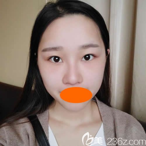 找贛州韓美何斌主任割7mm雙眼皮術(shù)前照片 找贛州韓美何斌主任割7mm雙眼皮術(shù)前照片