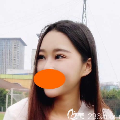 找贛州韓美何斌主任割7mm雙眼皮術(shù)后第19天效果 找贛州韓美何斌主任割7mm雙眼皮術(shù)后第19天效果