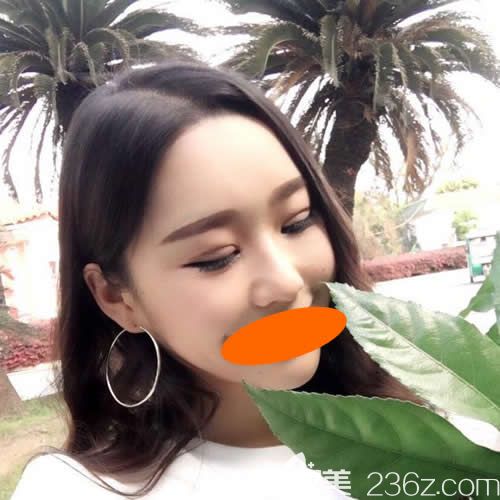 找贛州韓美何斌主任割7mm雙眼皮術(shù)后第10天效果 找贛州韓美何斌主任割7mm雙眼皮術(shù)后第10天效果