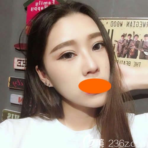 腫泡眼的我找贛州韓美何斌主任割7mm雙眼皮一個(gè)月后真的有了網(wǎng)紅雙眼皮