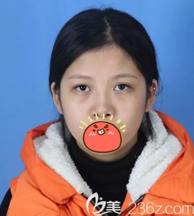 金華麗都朱紀國雙眼皮案例手術(shù)前