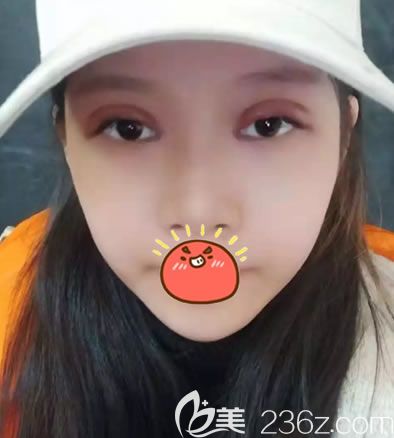 金華麗都朱紀國雙眼皮案例即刻效果