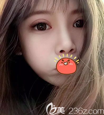 金華麗都朱紀國雙眼皮案例20天效果