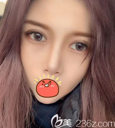 金華麗都朱紀國雙眼皮案例3個月效果