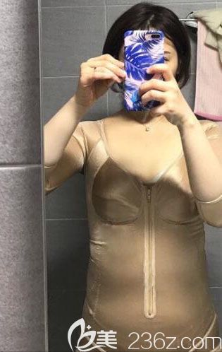 韓國(guó)UcanB腰腹+手臂吸脂術(shù)后13天效果圖