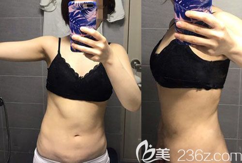 韓國(guó)UcanB腰腹部吸脂術(shù)+手臂抽脂案例術(shù)后恢復(fù)效果圖