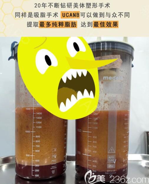 韓國(guó)UcanB提取更多純粹脂肪，脂肪抽出術(shù)后效果