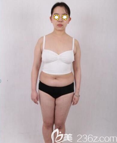 在沈陽百嘉麗做全身吸脂術(shù)前照 在沈陽百嘉麗做全身吸脂術(shù)前照