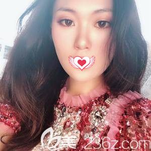 王亞勇為我這樣雙眼皮術(shù)后18天已經(jīng)消腫 王亞勇為我這樣雙眼皮術(shù)后18天已經(jīng)消腫