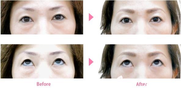 竹內(nèi)重夫祛眼袋案例