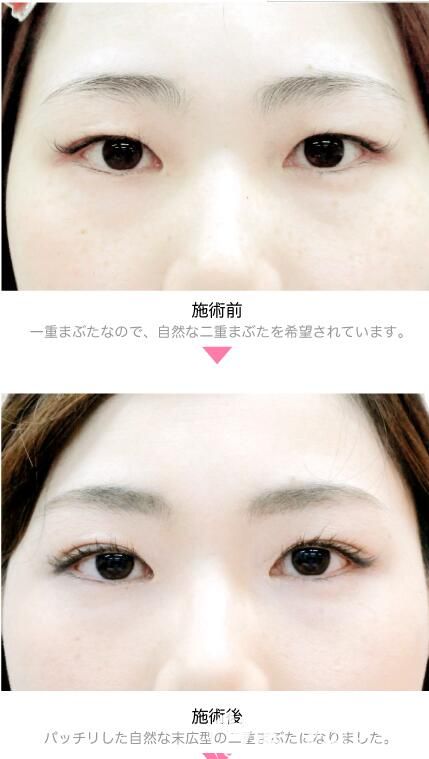 竹內(nèi)重夫埋線(xiàn)法雙眼皮