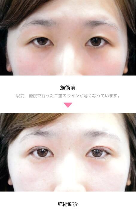 竹內(nèi)重夫全切法雙眼皮案例