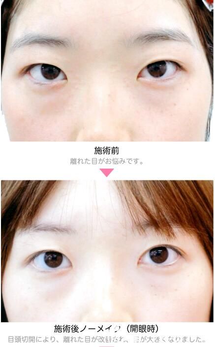 竹內(nèi)重夫開(kāi)內(nèi)眼角案例