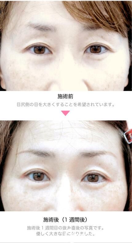 竹內(nèi)重夫開(kāi)外眼角案例