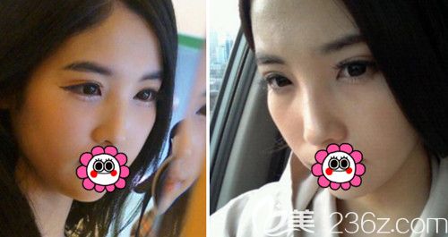 在韓國POP整形醫(yī)院做鼻綜合+全切雙眼皮修復(fù)術(shù)前 在韓國POP整形醫(yī)院做鼻綜合+全切雙眼皮修復(fù)術(shù)前