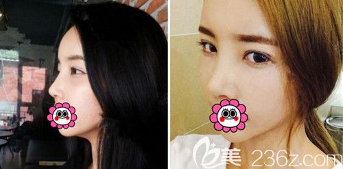 在韓國POP整形醫(yī)院做鼻綜合+全切雙眼皮修復(fù)術(shù)后1個(gè)月 在韓國POP整形醫(yī)院做鼻綜合+全切雙眼皮修復(fù)術(shù)后1個(gè)月