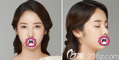 在韓國POP整形醫(yī)院做鼻綜合＋全切雙眼皮修復(fù)+全臉脂肪填充半年效果