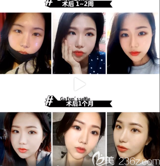 臉本臉骨整形外科facebone樸用南怎么樣